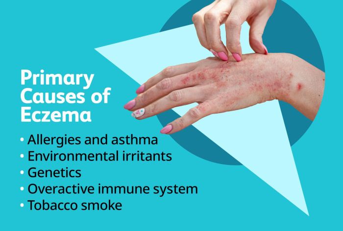 Causes of eczema flare-ups